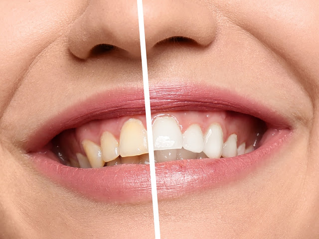 6 وصفات سحرية لتبييض الاسنان